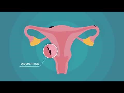 Is Surgery Right for Your Endometriosis? 3 Key Questions to Consider | UChicago Medicine OB/GYN