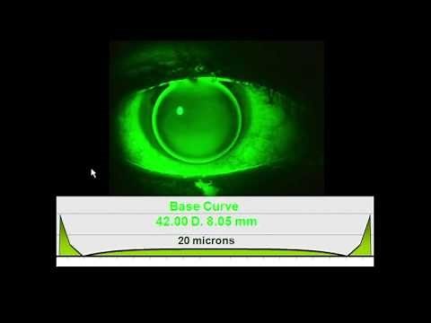 Fitting GP Lenses Part 2 - Mark Andre