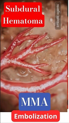 MMA embolization for Subdural hematoma. #neuroscience #mmaembolization #neuroir #sdh