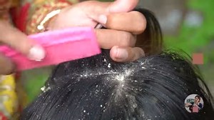 124K views · 924 reactions | Extreme Damage Dandruff - Dandruff combing and scratching -Itchy Dry scalp 525 | 33K | Facebook