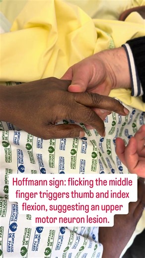 Hoffman sign