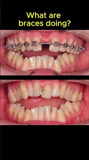 This is how protruding teeth are corrected with braces #orthodontist #braces