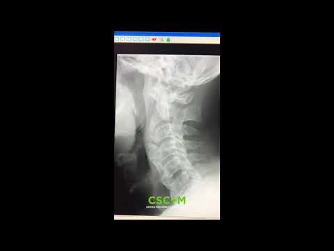 Diffuse Idiopathic Skeletal Hyperostosis (DISH), Explained by a Chiropractor