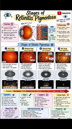 Retinitis Pigmentosa (RP) | Complete Revision | VisionDrifts