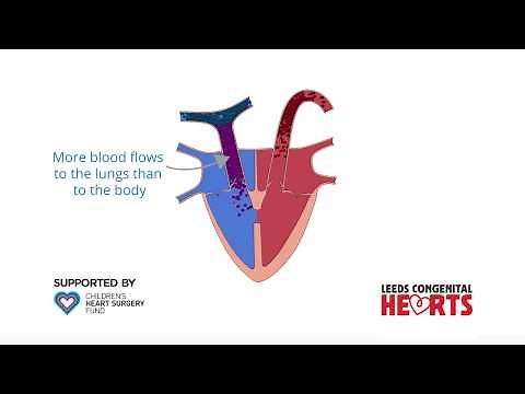 Ventricular Septal Defect