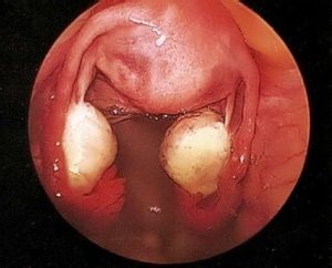 Fenbendazole and Ovarian Cancer
