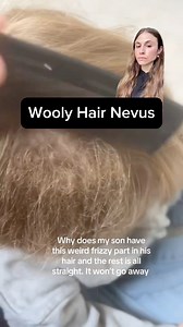 A patch of frizzy hair in a young child is seen with wooly hair nevus. #notmedicaladvice #woolyhair #birthmark #dermatologist | Dr Dray