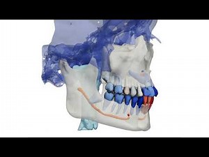 AI-powered CBCT segmentation by DentalMesh