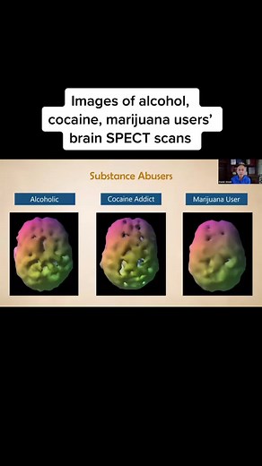 Understanding Substance Abuse: Brain Spect Scans and Their Impact