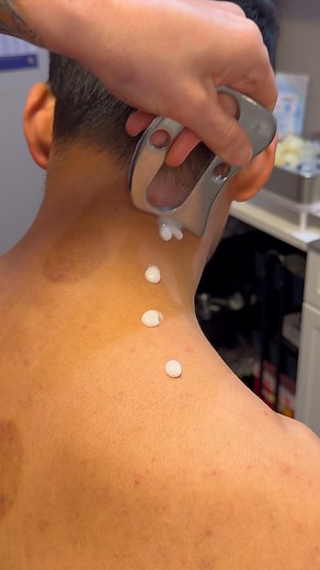 🏆 Instrument Assisted Soft Tissue Mobilization (IASTM) helps break up scar tissue and fascial restrictions using specially designed tools. This technique promotes better circulation, restores mobility, and speeds up recovery from overuse or injury. #IASTM #SoftTissueTherapy #ChicagoChiropractic #Chiropractor#drkyleross —— | Dr_kyleross