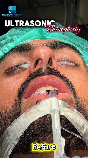 Expert Rhinoplasty Techniques in Pakistan and Turkey