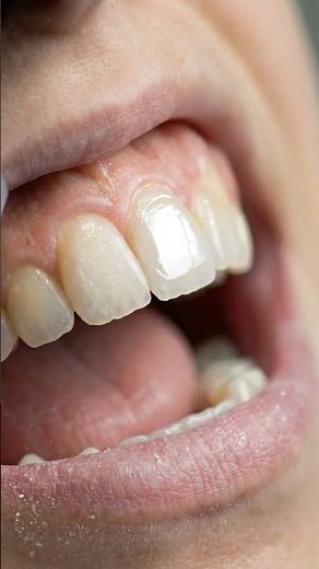 Reattaching a Broken Tooth Fragment in 5 Minutes
