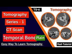 Tomography Series -1, CT Temporal Bone (Rad-Tutorial)/TS-6.