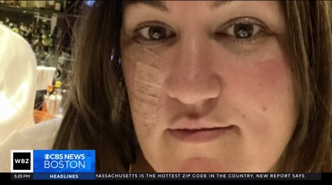 New technology helps doctors track moles that may be melanoma