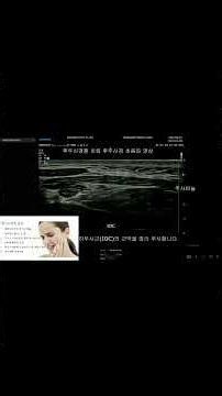 두통 때문에 10년간 매일 먹던 마약진통제를 끊었습니다 #short #통증의학과 #pdrn주사 #강남연세신통의원 #후두신경차단술