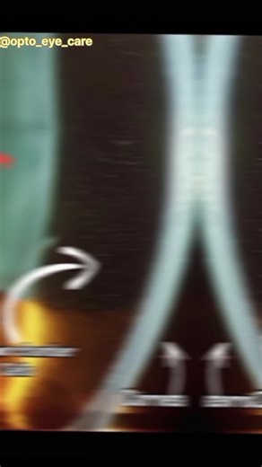 Opto Eye Care | Understanding Anterior Chamber Cells on Slit Lamp Ever wondered what those tiny white dots in the eye mean? 👁️✨ This slit-lamp view shows... | Instagram