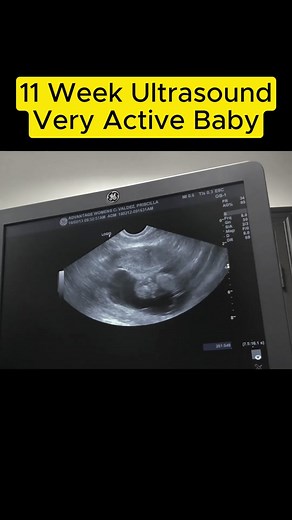 Very Active Baby at 11 Weeks Ultrasound