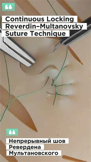 Reverdin–Multanovsky Continuous Suture Technique