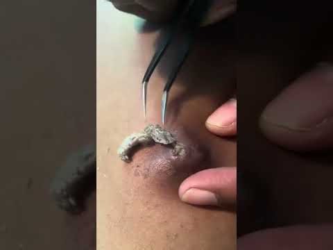 At home Cyst pop and HUGE sac removal DIY !
