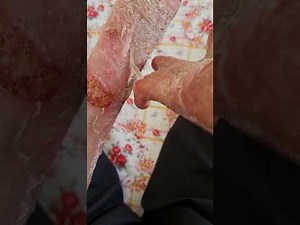 How to peel off dead skin | ASMR