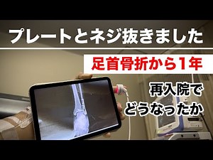 足首骨折から1年【抜釘手術】金属板とネジを抜く