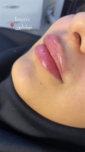 ‎⚜️کلینیک زیبایی درمانی آمیتیس⚜️‎ on Instagram‎: "تزریق ژل لب برای کلاینت عزیز + بلافاصله بعد از تزریق❤️ ۰ ۰ ۰ ۰ ۰ ۰ ۰ ۰ ۰ #زیبایی #اکسپلور #نیشابور #ترند #دخترونه #فان #نیشابوریا #explore #reels"‎