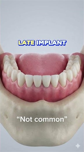 Can Dental Implants Fail Years Later?