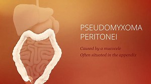 Informative animation shows how PMP is caused