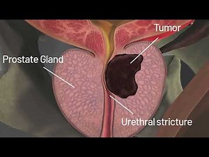 prostate: Discover the 7 Symptoms of a Sick Prostate That You Should Not Ignore
