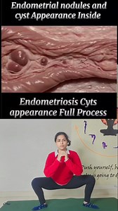 Endometriosis Endometriosis is a condition in which cells similar to the lining of the uterus, or endometrium, grow outside the uterus. Endometriosis often involves the pelvic tissue and can envelop the ovaries and fallopian tubes. It can affect nearby organs, including the bowel and bladder. Adding these practices in your routine daily for 10 minutes will help you to heal . To join my online yoga fitness class you can dm me | Fit with Priya