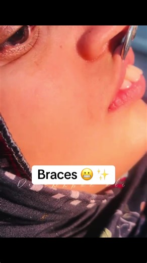 Understanding the Braces Journey with Sami Dental Clinic