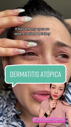 Dermatitis Atópica: Síntomas, Tratamiento y Consejos Útiles
