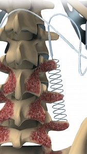 36K views · 281 reactions | Bone growth stimulation, or BGS, is a...