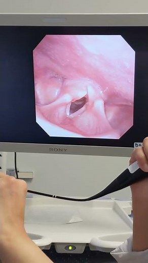 Vocal cords (Paralyzed right vocal cord)