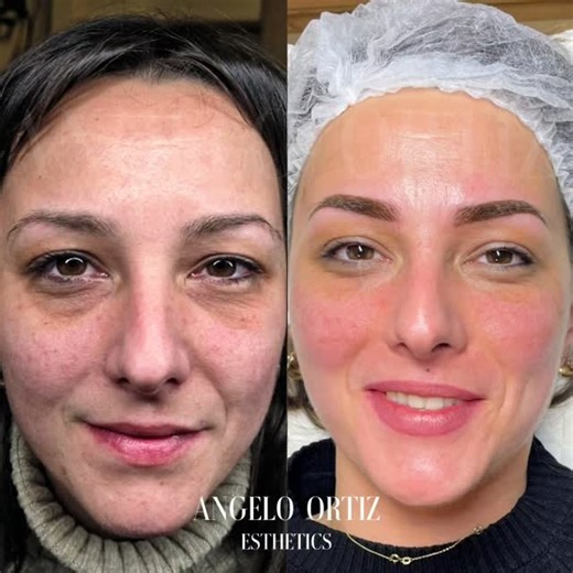 Angelo Ortiz | Fibroblast plazma organski lifting je najnovija nehirurška tehnika zatezanja kože koja je 100% bezbedna. Ne uključuje ubrizgavanje... | Instagram