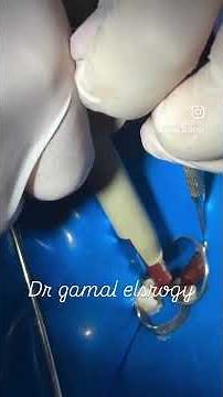 Partial Pulpotomy with MTA Putty | Step-by-Step Clinical Case