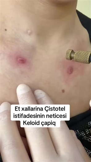 Capiq#scar #keloid #xal #deri #keşfet