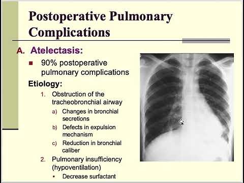 Post operative Pulmonary complications | General Surgery