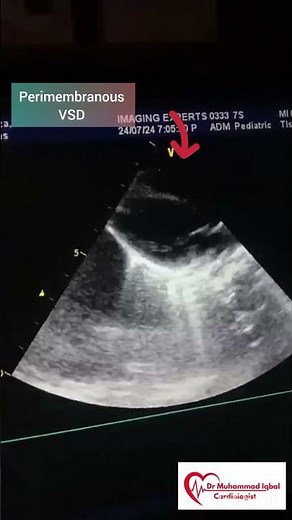 Perimembranous VSD | VSD | congenital heart anomalies | VSD Echo