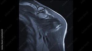 Compare MRI Shoulder joint or Magnetic resonance imaging of Shoulder Joint Coronal T2W and T2W FS for diagnosis arthritis and including tears and impingement.
