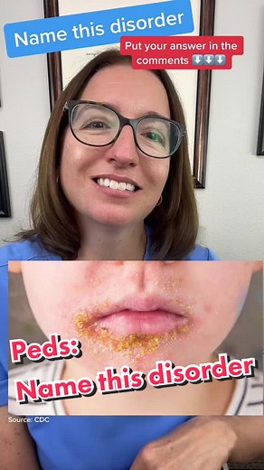 Name this disorder! Cathy provides clues ro help you name this pediatric diaorder. #nursingschool #NCLEX #nursingstudent #leveluprn #ati #hesi #peds #nursingexams