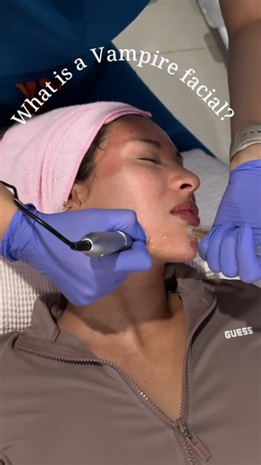 VOLUMÉ AESTHETICS on Instagram: "What is a vampire facial? A vampire facial, also known as a PRP facial, is a cosmetic treatment that combines microneedling with platelet-rich plasma (PRP) derived from your own blood to rejuvenate the skin We also use NMN which has even more benefits Right now we’re running a 40% off special, dm us or call (213)908-7000 to book #volumemdspa #vampirefacial #medspainla"