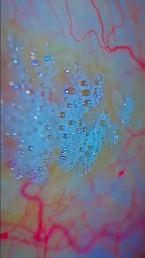Toxoplasmosis Retinochoroiditis: A Rare Eye Infection | Bharti Eye Hospital Case