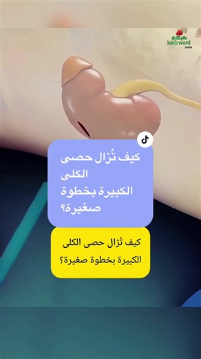 إزالة حصى الكلى الكبيرة بخطوات بسيطة