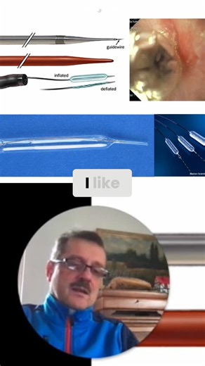 EndoCollab | GI Endoscopy Community on Instagram: "Dilation strategies for esophageal strictures: balloon, Savary guidewire, or bougie cath? Bougie cath advantages: transparent, allows visualization during dilation. See laceration results. Watch the full lecture and explore our complete course library at EndoCollab.com. #gastroenterology #gastroenterologia #endoscopy #endoscopia #esophagealdilation"