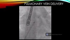 Atrial Septal Defect: Should You Use TEE and General Anesthesia