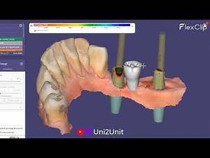 Exocad 3-Unit Bridge Design | Pontic on Tooth 5