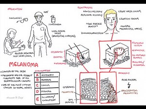 Melanoma - Overview (signs and symptoms, pathology, risk factors, treatment) • Video • MEDtube.net