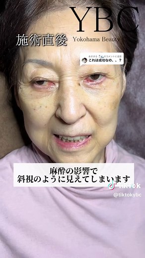 @あきまる 🧂🌊に返信 🎉伝説のクマ取り🎉 〜美容医療にかける熱意 それが私の強みです〜 現在開院記念モニター絶賛募集中🌟 最大半額も❣️まずは無料相談！ 💎私が選ばれる理由💎 🏆TikTokフォロワー10万超 🏆埼玉県口コミNo.1 🏆症例数1万件 🏆有名人多数施術担当 🏆元大手美容外科院長兼技術指導医 🏆圧倒的に症例が綺麗 🥇YBCのクマ治療はここがすごい❗️ ◾️ダウンタイムが短い 内出血、腫れを最小限に抑えて、ダウンタイムを短くする工夫をしております！ ◾️手術が早いから楽 手術も他院だと30分以上かかるところを、慣れてますので15分くらいで終えます。 ◾️リスクの高い脂肪吸引・注入がいらない 脂肪注入と聞くと「安全そう」と思えるかもしれませんが、実はとてもリスクも痛み、ダウンタイムも伴う治療です。そういった負担をかけるオプションを必要とせずにしっかり綺麗に仕上げます。 ◾️安心の価格 脂肪注入も必要ないため料金も手頃な価格になります。 🏥YBC横浜美容外科池袋院 〒171-0022 東京都豊島区南池袋2-31-5 南大和ビル2F 03-6709-