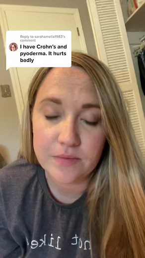 Reply to @sarahamelia1983 here are some treatments options and how I keep a bag on with pyoderma around the stoma! #pyoderma #crohns #pyodermagangrenosum #crohnsdisease #stoma #ostomy #ostomylife